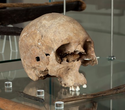 Kranium med fyrkantigt hål i tinningen i en museumsmonter. Kraniet saknar underkäke. Några tänder sitter kvar i överkäken. Fotograferat snett framifrån.