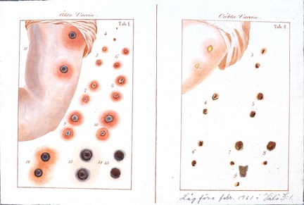 Bilder av koppor efter oäkta och äkta smittkoppsvaccin, utan årtal